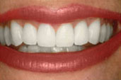 Whitening after
